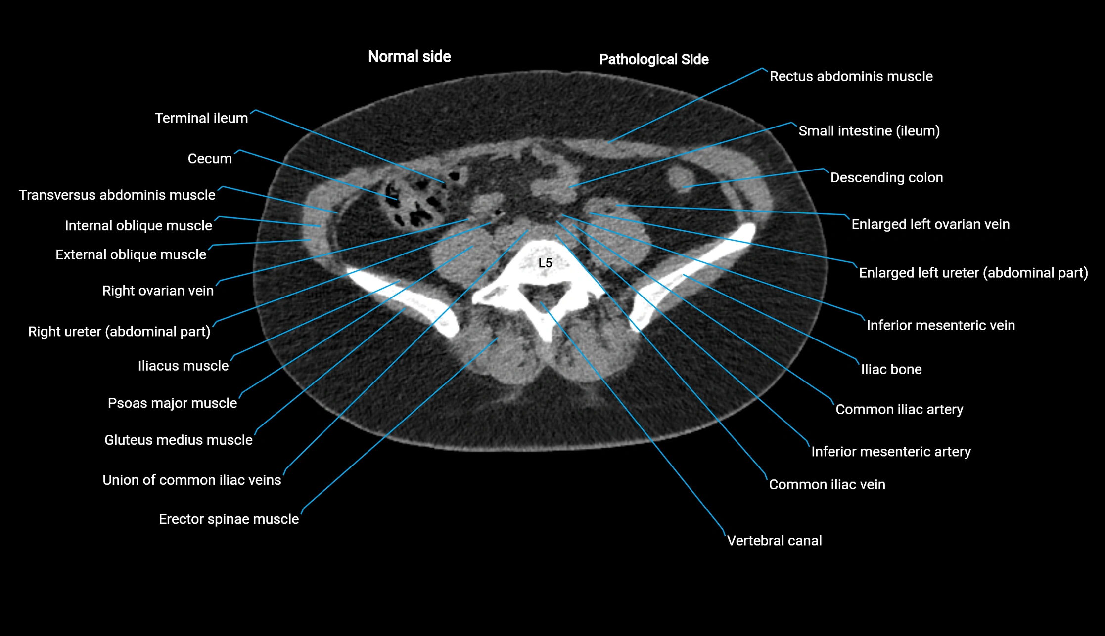 CT KUB axial cross sectional anatomy  radiology image -img-00201-00101.webp